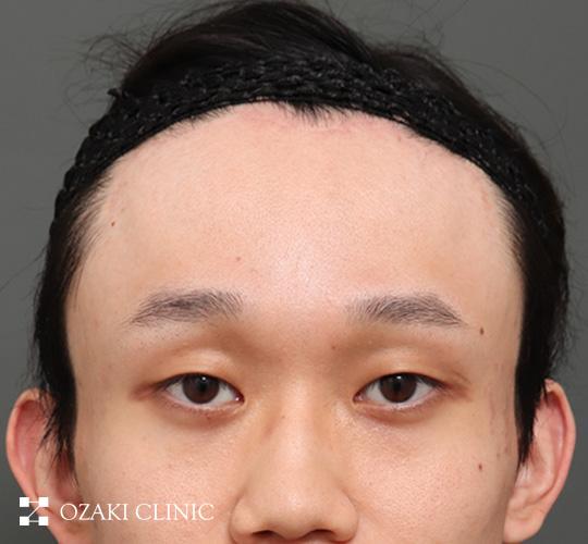 20代男性の額縮小 After 症例写真