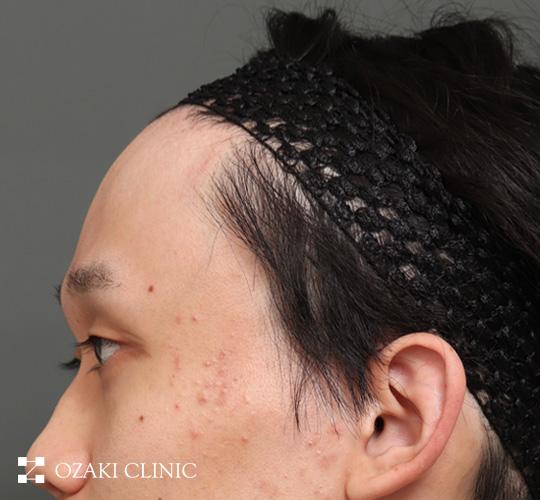 20代男性の生え際前進術 After 症例写真