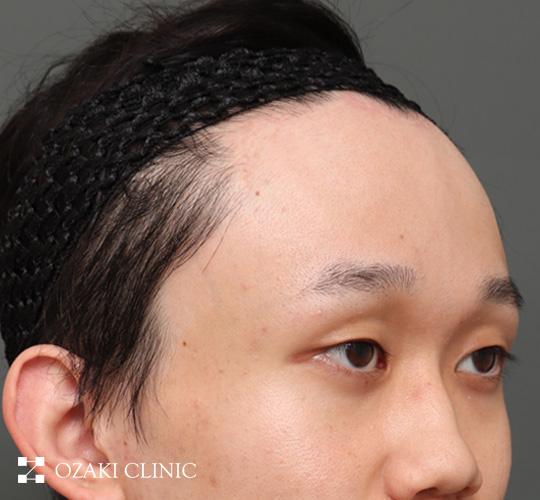 20代男性の額縮小 After 症例写真