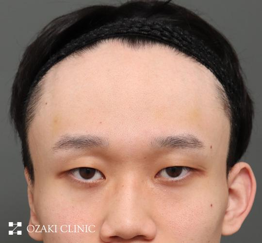 20代男性の額縮小 Before 症例写真