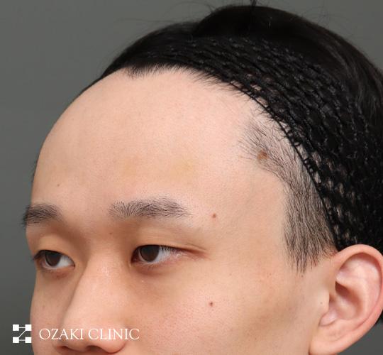 20代男性の額縮小 Before 症例写真
