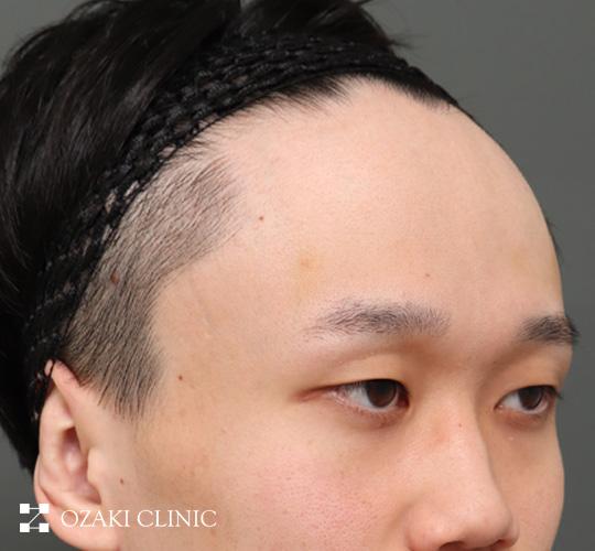 20代男性の額縮小 Before 症例写真