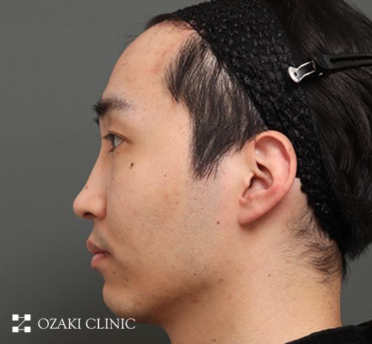 20代男性の生え際前進術 After 症例写真