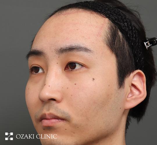 20代男性の額縮小 After 症例写真