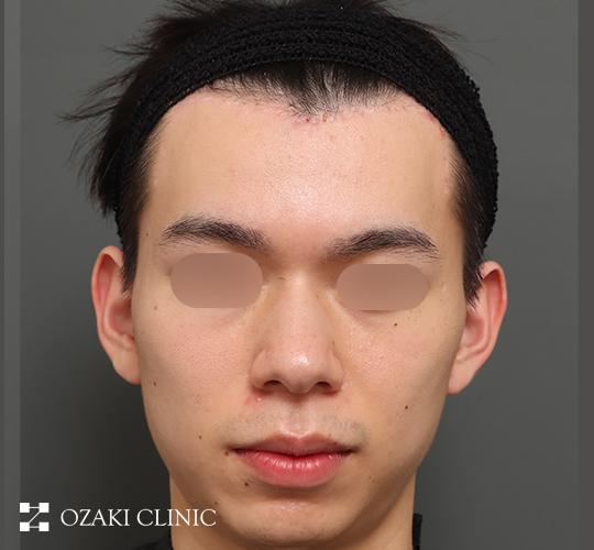 20代男性の額縮小 After 症例写真