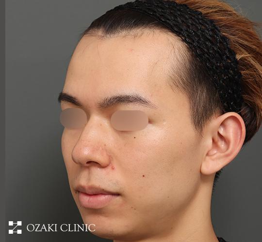 20代男性の生え際前進術 Before 症例写真