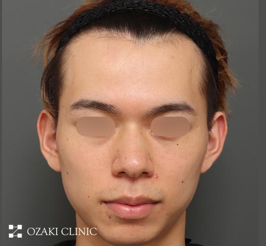 20代男性の額縮小 Before 症例写真