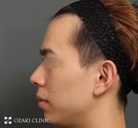 20代男性の額縮小 Before 症例写真