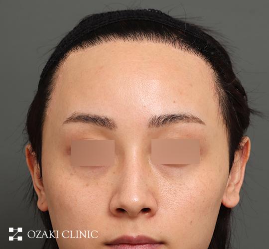 20代男性の額縮小 After 症例写真