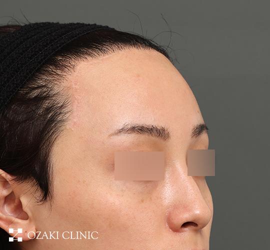 20代男性の額縮小 After 症例写真