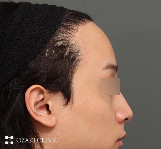 20代男性の生え際前進術 After 症例写真