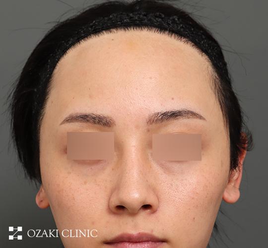 20代男性の額縮小 Before 症例写真