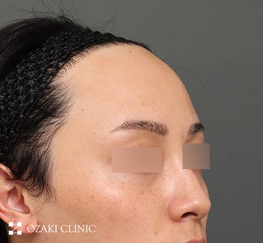 20代男性の額縮小 Before 症例写真