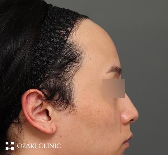 20代男性の生え際前進術 Before 症例写真