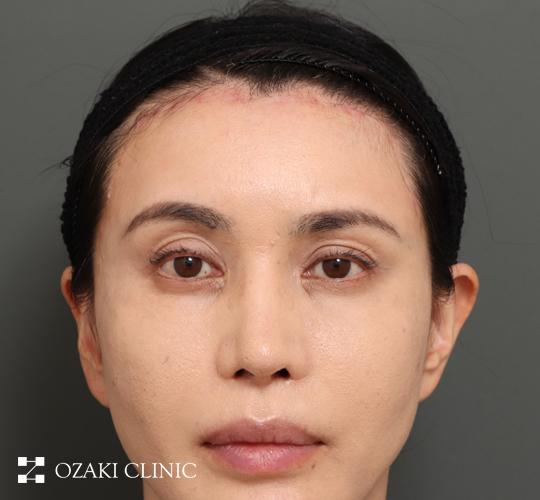 40代女性の額縮小 After 症例写真