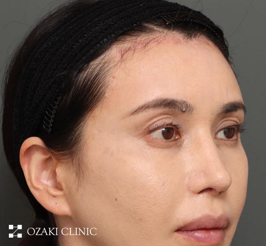 40代女性の額縮小 After 症例写真