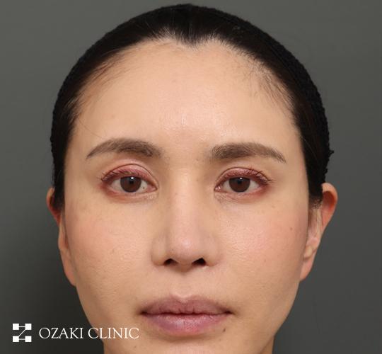 40代女性の額縮小 Before 症例写真