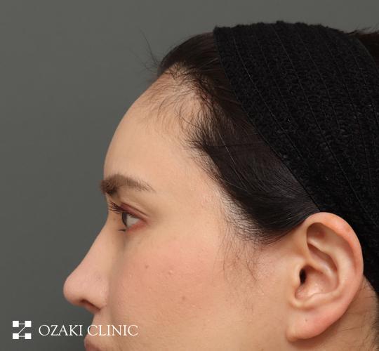 40代女性の額縮小 Before 症例写真