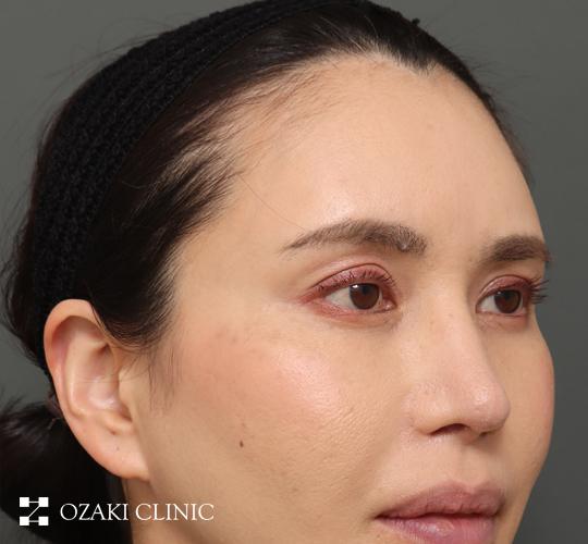 40代女性の額縮小 Before 症例写真