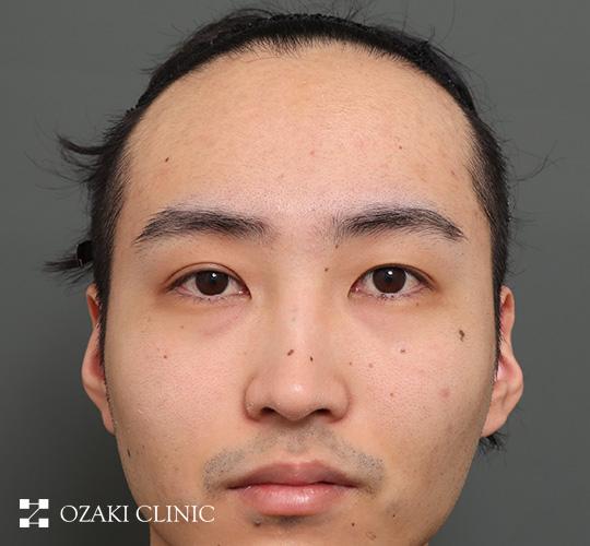 20代男性の額縮小 Before 症例写真