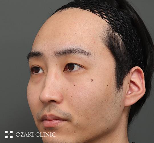 20代男性の額縮小 Before 症例写真