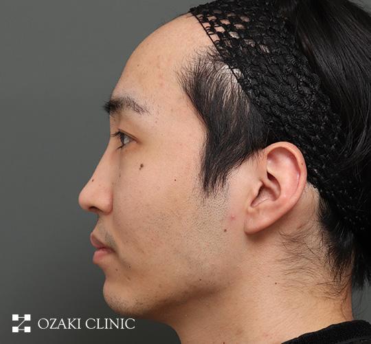 20代男性の生え際前進術 Before 症例写真