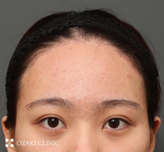 20代女性の生え際前進術 After 症例写真