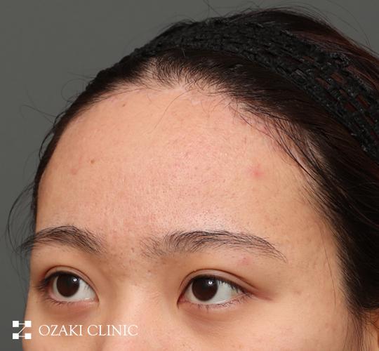 20代女性の額縮小 After 症例写真