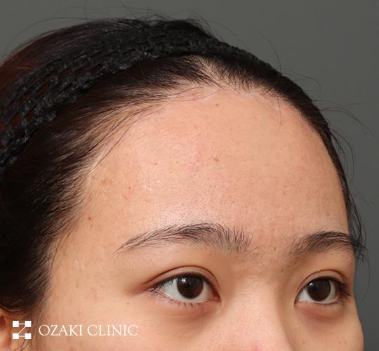 20代女性の額縮小 After 症例写真