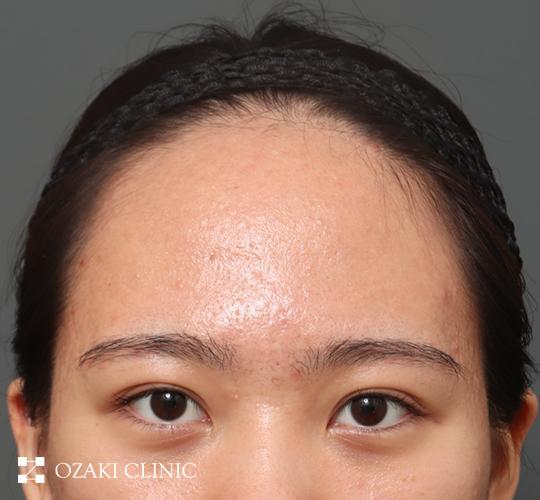 20代女性の生え際前進術 Before 症例写真