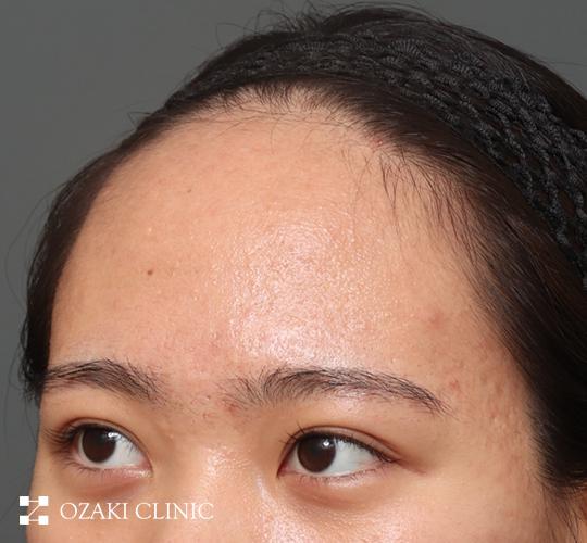20代女性の額縮小 Before 症例写真