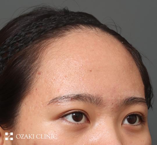 20代女性の額縮小 Before 症例写真