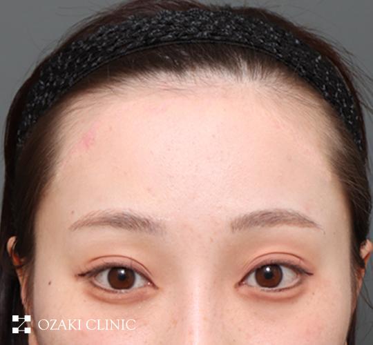 20代女性の額縮小 After 症例写真