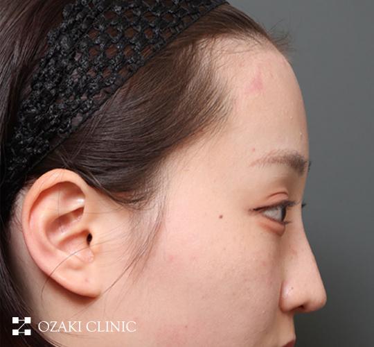 20代女性の額縮小 After 症例写真