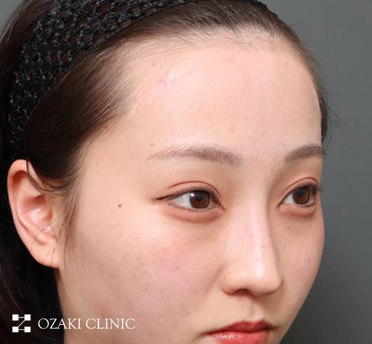 20代女性の前額リフト After 症例写真