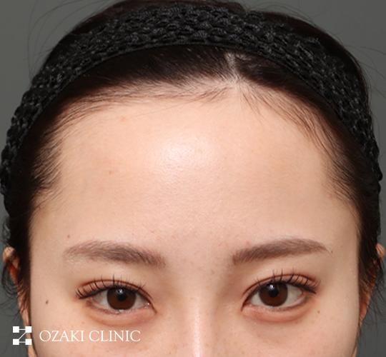 20代女性の額縮小 Before 症例写真