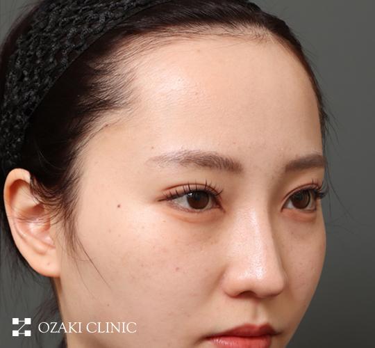 20代女性の前額リフト Before 症例写真