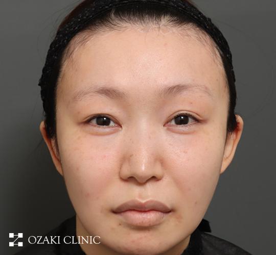 20代女性の額縮小 After 症例写真