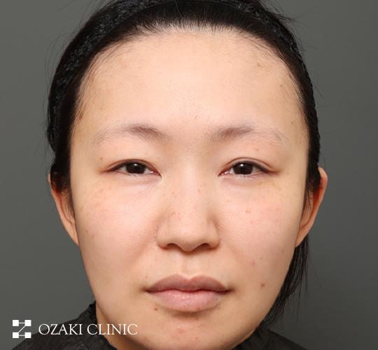 20代女性の額縮小 Before 症例写真