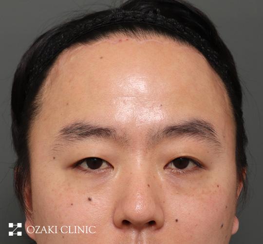 30代男性の額縮小 After 症例写真