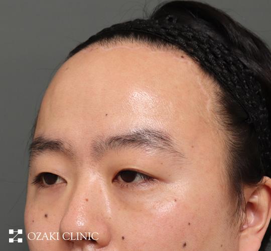 30代男性の生え際前進術 After 症例写真