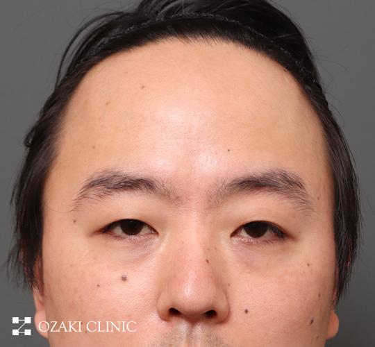 30代男性の額縮小 Before 症例写真