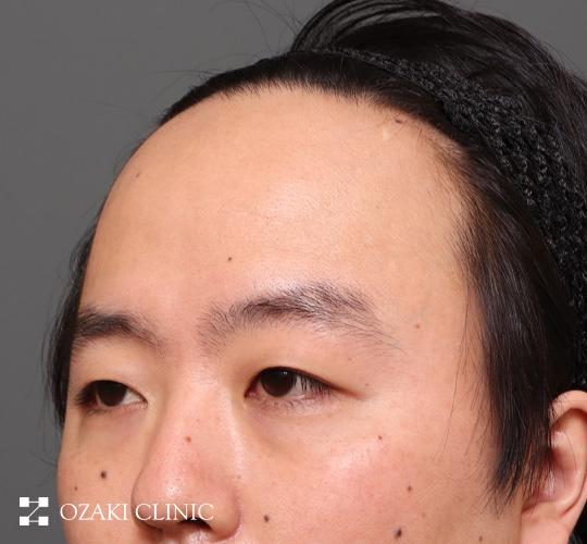 30代男性の生え際前進術 Before 症例写真