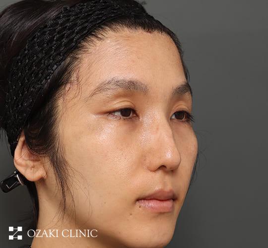 30代男性の生え際前進術 After 症例写真