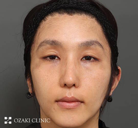 30代男性の額縮小 After 症例写真