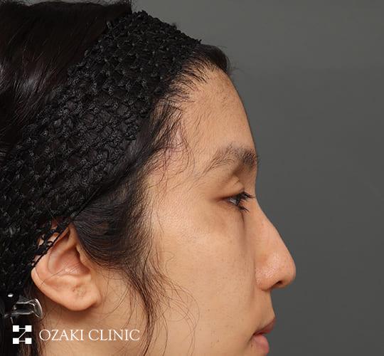 30代男性の額縮小 After 症例写真