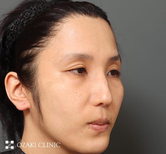 30代男性の生え際前進術 Before 症例写真