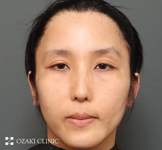 30代男性の額縮小 Before 症例写真