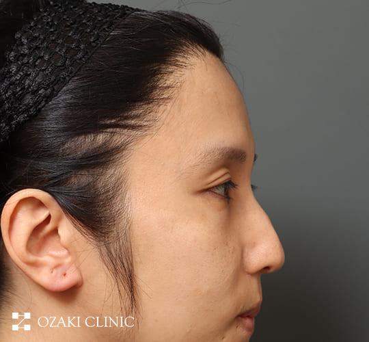 30代男性の額縮小 Before 症例写真