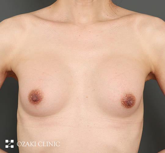 40代男性のMTF豊胸（トランスジェンダー豊胸） After 症例写真